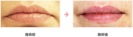 唇の整形（ボトックス）症例：口角下制筋への注射