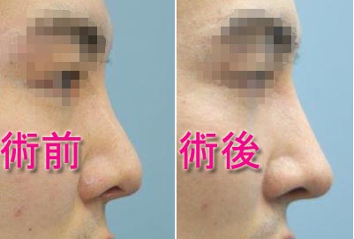鼻中隔延長＋Ｉ型プロテーゼ