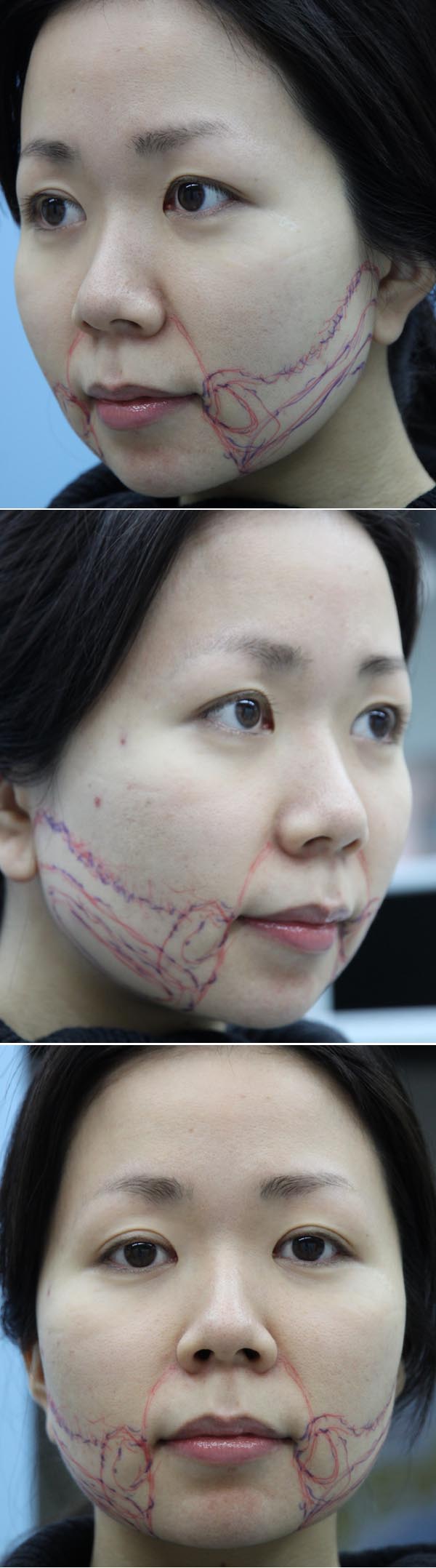 頬の脂肪吸引はフェイスラインを主に吸引 美容外科ヤスミクリニック