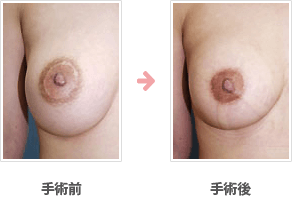 乳輪縮小他院手術