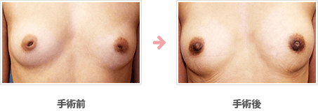 陥没乳頭：皮下軟部組織弁を利用した当院独自の術式