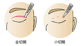 全切開と小切開の切開