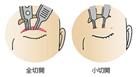 全切開と小切開の内部処理