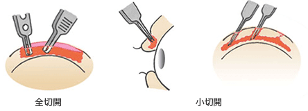 全切開と小切開の内部処理の断面図