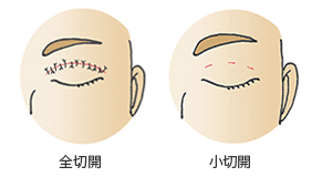 全切開と小切開の閉瞼時の傷(術直後）