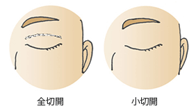 全切開と小切開の閉瞼時の傷(術直６ヶ月以降）