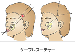 ケーブルスーチャーとは何か？