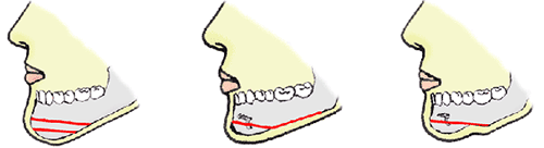 あごの骨切り・骨削り