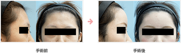 額の整形(小切開・ハイドロキシアパタイト）症例A