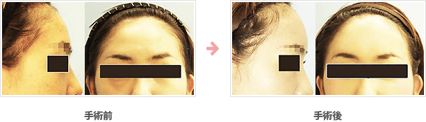 額の整形(小切開・ハイドロキシアパタイト）症例B