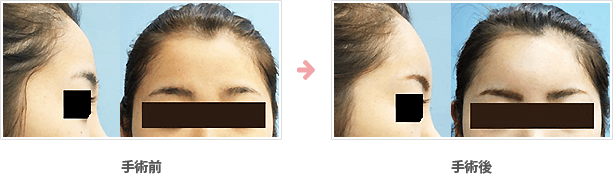 額の整形(小切開・ハイドロキシアパタイト）症例C