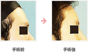 額の整形(小切開・ハイドロキシアパタイト＋鼻シリコンプロテーゼ）症例A