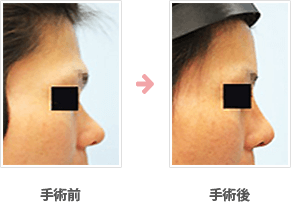 額の整形(小切開・ハイドロキシアパタイト＋鼻シリコンプロテーゼ）症例B