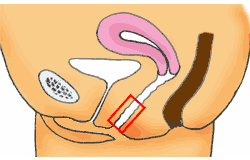 膣縮小は粘膜と筋層をどう扱うか？