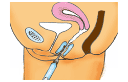 膣前庭部注入法による膣縮小術