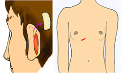 側鼻中隔延長に使う軟骨の採取と傷