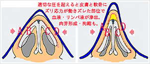 鼻尖手術後のケア