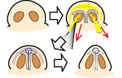 鼻尖縮小手術の概略