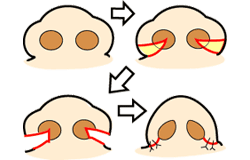 鼻翼縮小 外側＋鼻孔縁(底)＋内側切除