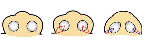 鼻翼縮小　鼻孔縁(底)切除