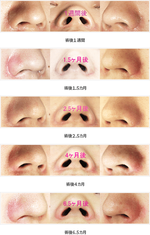 小鼻縮小：内側＋鼻孔底＋外側切除法症例A前面