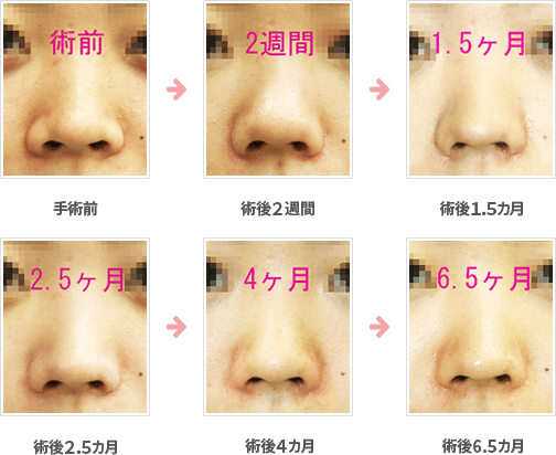 小鼻縮小の症例：内側＋鼻孔底＋外側切除法症例A