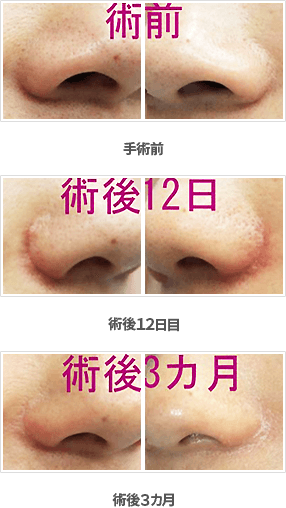 小鼻縮小の症例：内側＋鼻孔底＋外側切除法症例A手術前