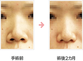小鼻縮小：内側＋鼻孔底＋外側切除法症例B