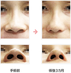  小鼻縮小：内側＋鼻孔底＋外側切除法症例C