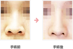  小鼻縮小：外側＋内側＋鼻孔底切除法