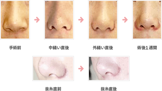 小鼻縮小：外側＋内側＋鼻孔底切除法