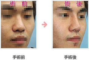 隆鼻シリコンプロテーゼ（鼻根部～鼻尖部）症例A