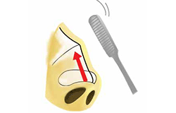 鼻尖縮小手術の概略