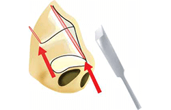 鼻尖縮小手術の手術範囲拡大