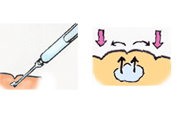 ヒアルロン酸注入で皺(しわ)が持ち上がる仕組み