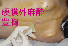 硬膜外麻酔：硬膜外ブロック - 美容外科ヤスミクリニック