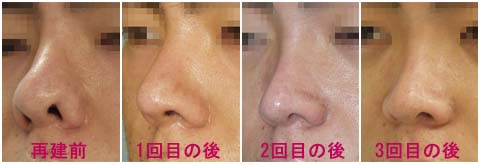 鼻尖縮小、鼻孔縁下降、プロテーゼ入替、鼻先軟骨移植