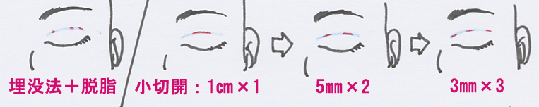 二重：小切開の傷の変遷