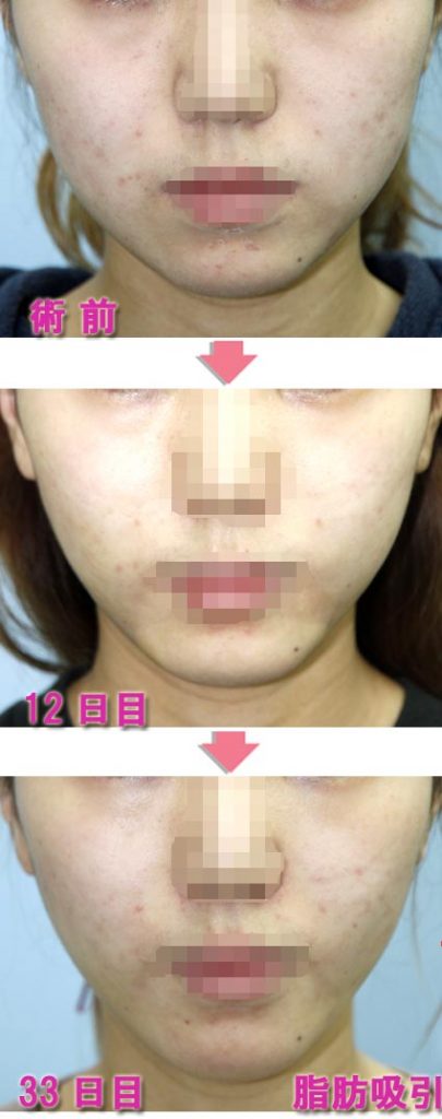 頬脂肪吸引 美容外科ヤスミクリニック