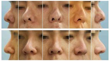 鼻変形の修正前と修正後（横幅短縮）のコピー