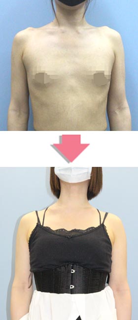 肩幅を狭く「なで肩」にする手術