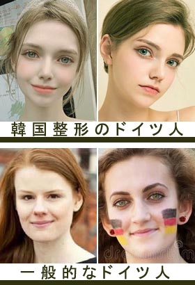 韓国整形をしたドイツ人女性 美容外科ヤスミクリニック