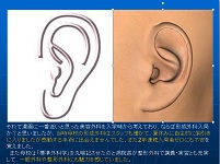 小耳症の再建（肋軟骨フレーム）