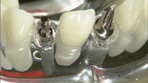 歯のインプラントのトラブルと美容整形のトラブルは似ている