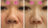 団子鼻の鼻尖縮小 美容外科ヤスミクリニック