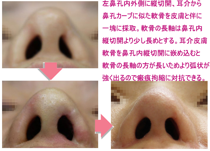 composite graft