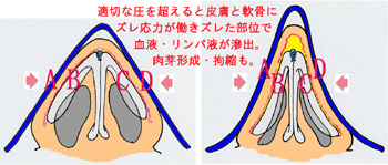 鼻尖縮小後に自宅で使用するギブスの危険性