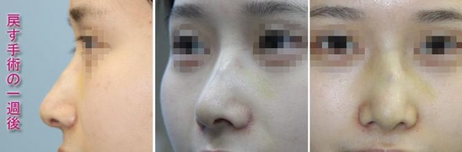 隆鼻シリコンプロテーゼ、鼻尖縮小、鼻翼縮小