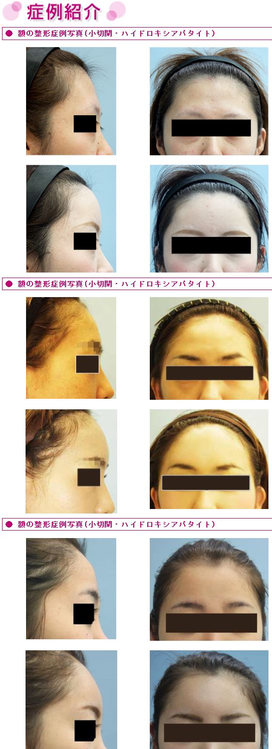 額を丸くする治療 アパタイト手術 美容外科ヤスミクリニック