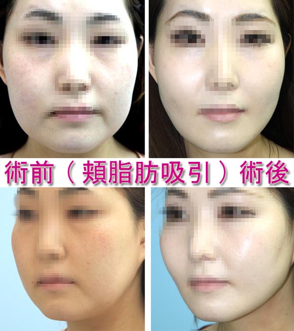 頬脂肪吸引の術後に気をつけることや合併症 美容外科ヤスミクリニック
